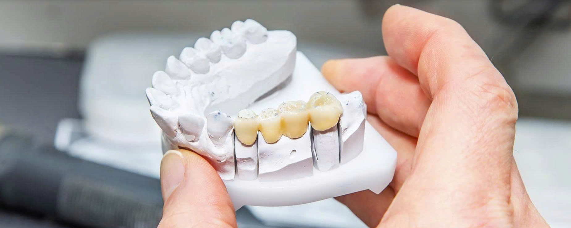 Dental Bridges in Vietnam: Cost, Types & Everything You Need to Know