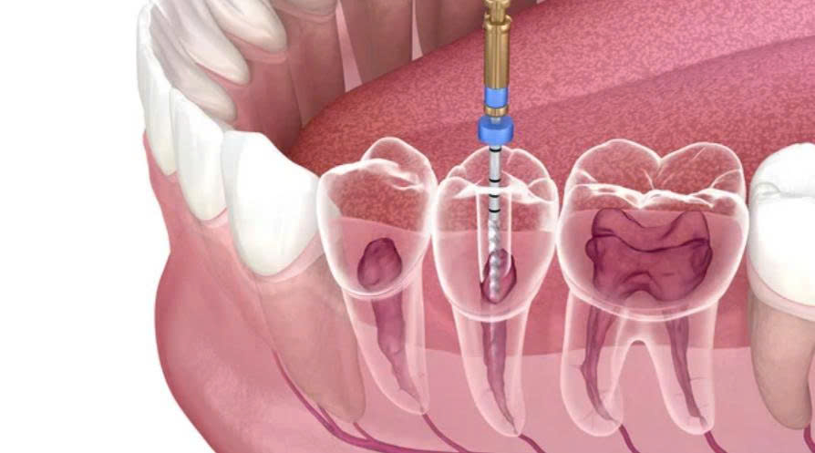 Root Canal Treatment in Vietnam: Cost, Process & What to Expect in 2026