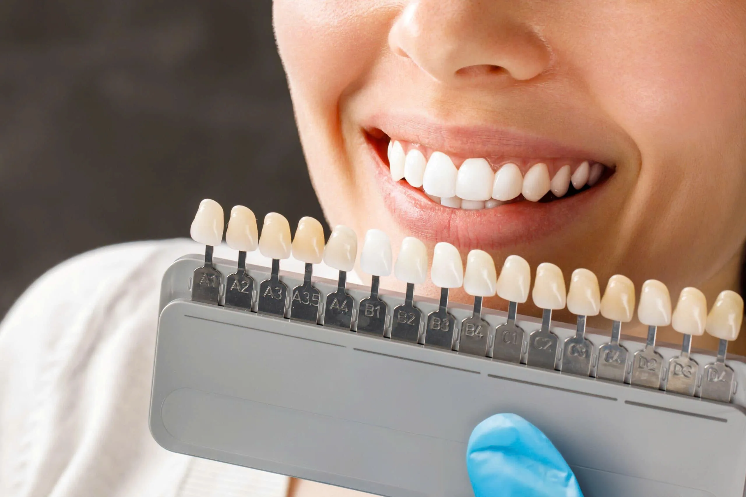 Porcelain Veneers in Vietnam: Cost, Quality & What to Really Expect in 2026