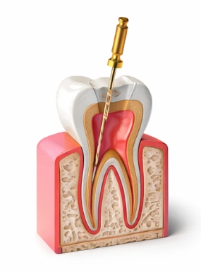 Root Canal